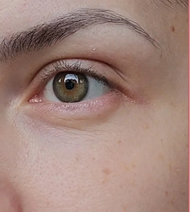 After — under-eye area