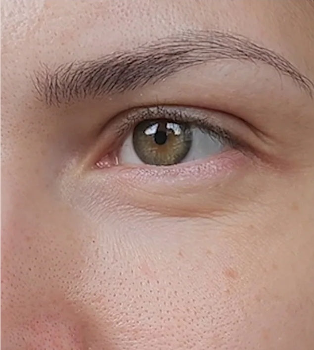 Before — under-eye area